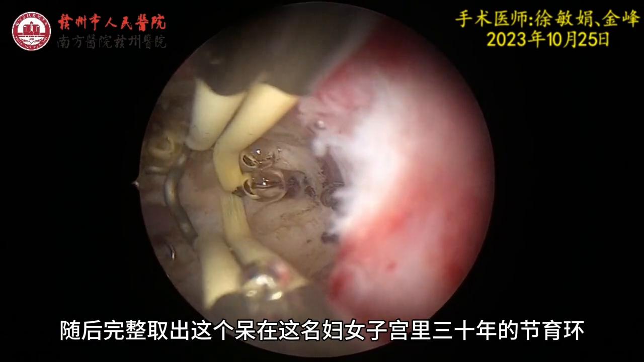 关于元宫型CU365节育环放取视频,你想知道的都在这里 关于元宫型CU365节育环放取视频,你想知道的都在这里