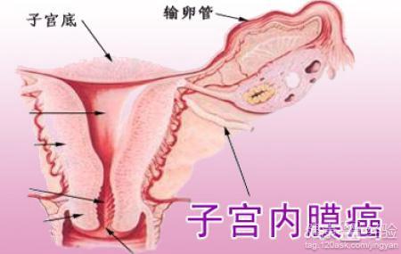 女子长期月经不调查出子宫内膜癌
